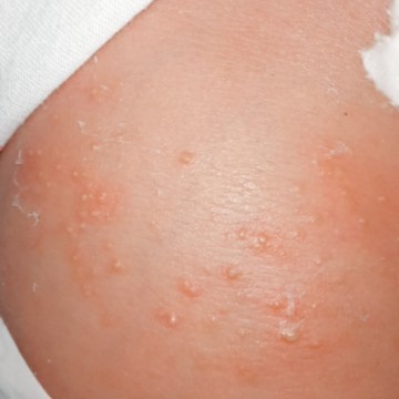 skin rashes