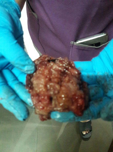Sharing my Endometriotic Cyst CS Operation