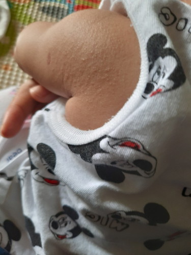 ลูกเป็นผดผืนค่ะ