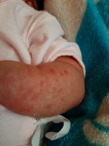 rashes