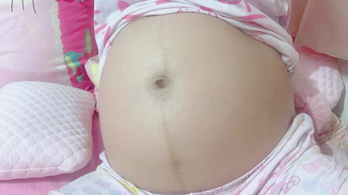 ทำไมบริเวณสะดือ ถึงเป็นคล้ำๆ ช้ำๆคะ