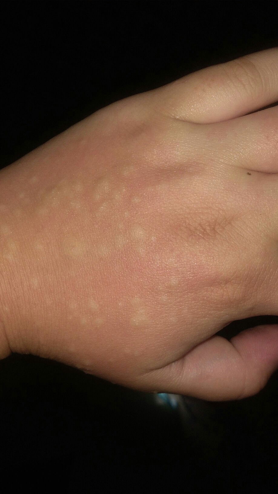 Alergi setelah melahirkan