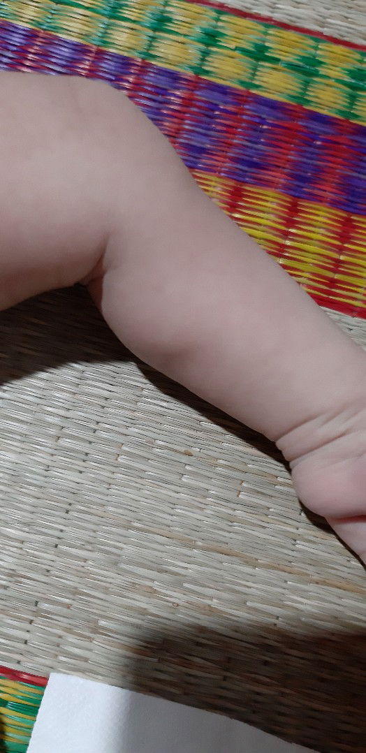 nổi cục ở chân