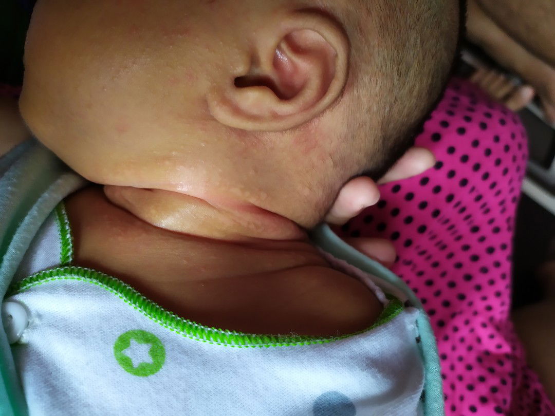 kulit bayi kayak panu