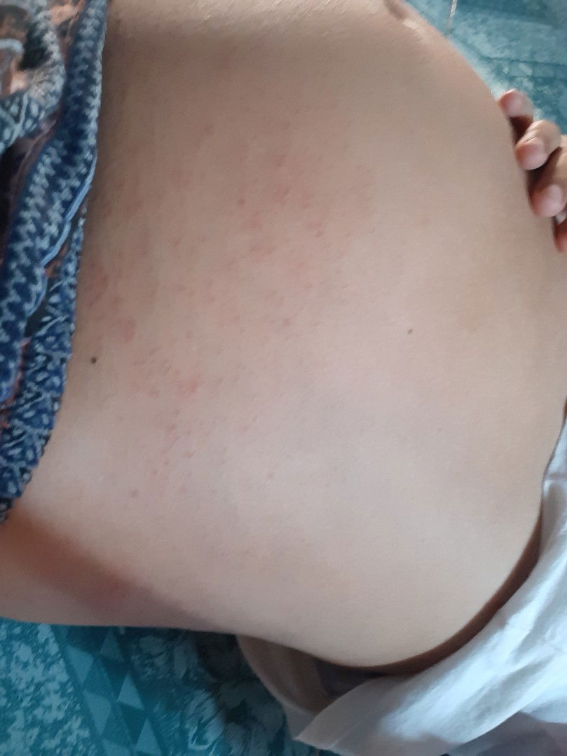 ผื่นขึ้น