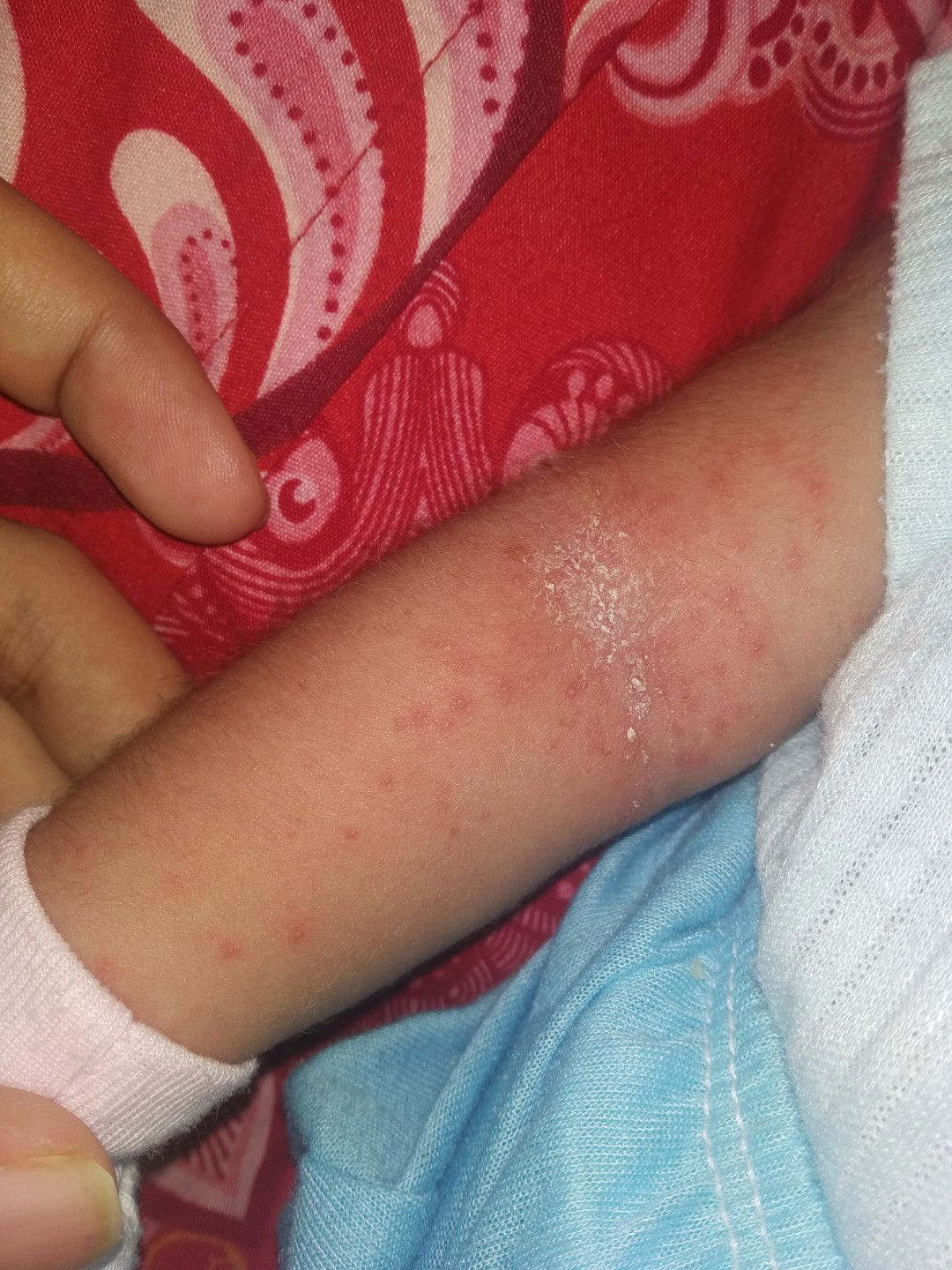 Milia jerawat bayi atau alergi???