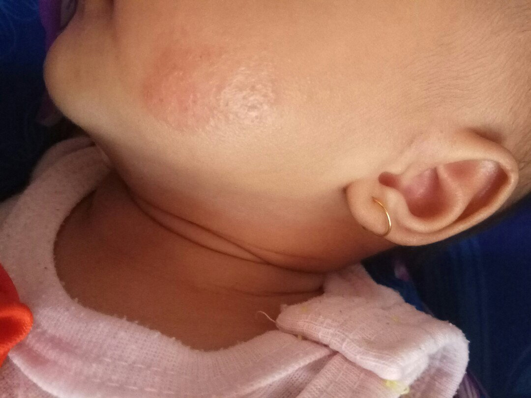 gatal pada bayi