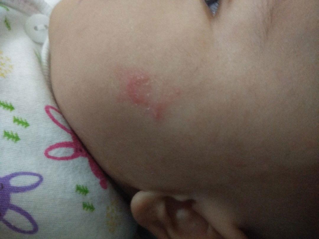 bruntusan merah di pipi kiri