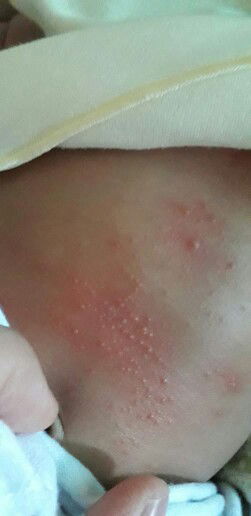 bintik merah di dada