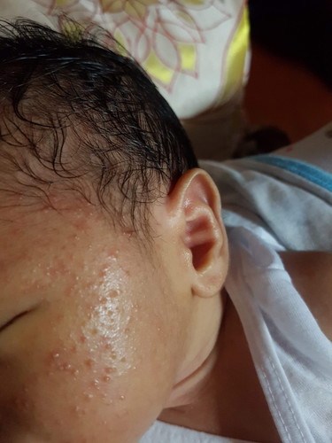Rashes