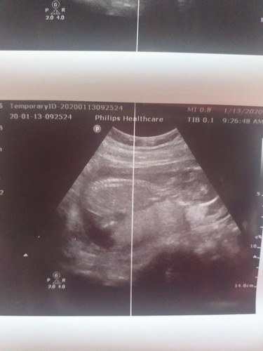 อัตตร้าซาว17w5d