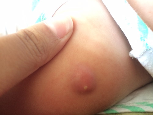 ปลูกฝี