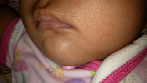 bintik2 sekitar bibir