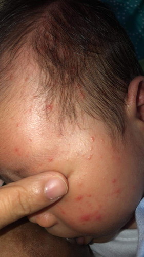 Baby Acne/ Rashes