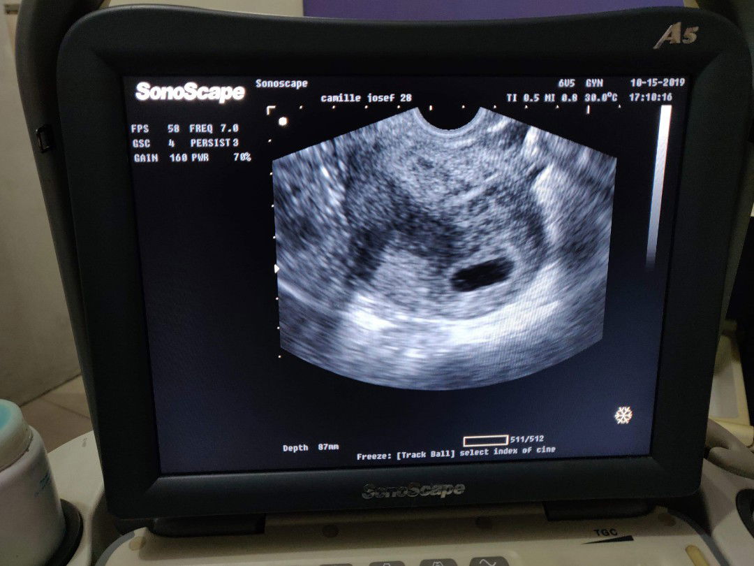 preggy pero di mkita sa ultrasound
