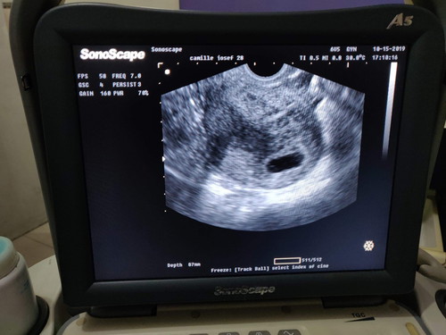 preggy pero di mkita sa ultrasound