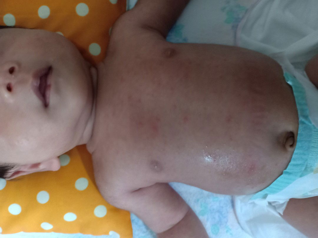 ruam pada kulit bayi