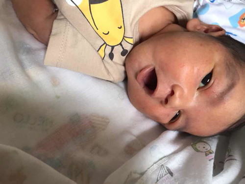 น้องมีผื่นแดงๆเต็มหน้าเต็มตัวเลยคะ