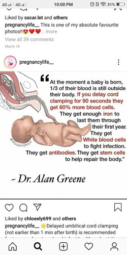 Ambilical Cord Clamping.