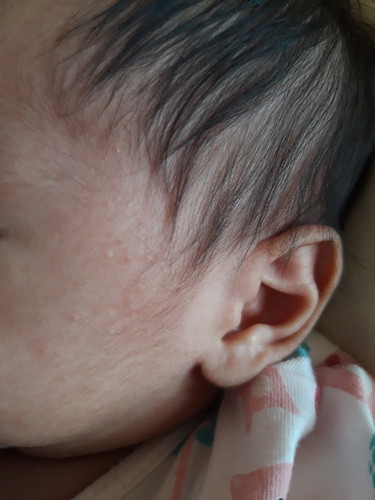 Is this Rashes?