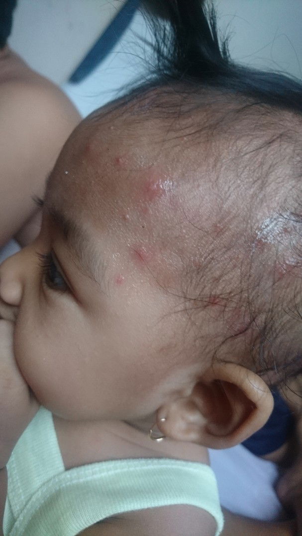 Ruam Merah Di Dahi Dan Kepala