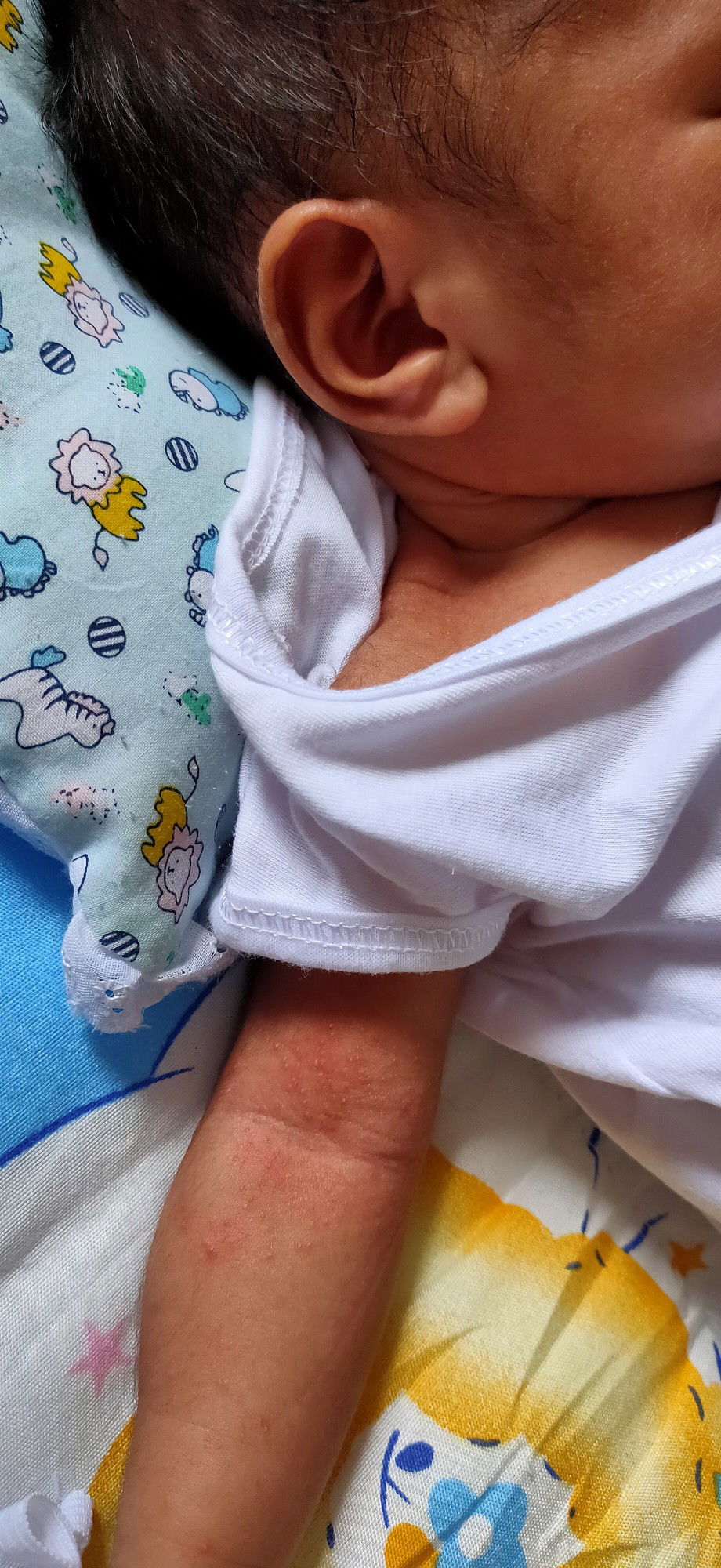 Rashes 11days old baby