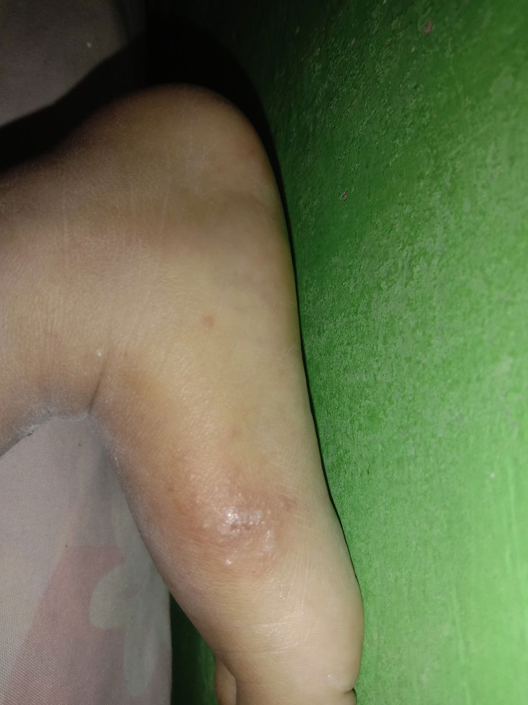 bentol bentol merah dan ber air