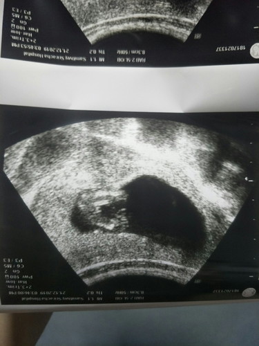 13 week เห็นเพศแล้วคร่า