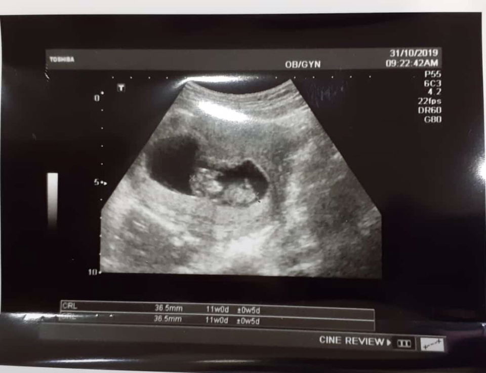 Hamil anak pertama dgn mioma uteri