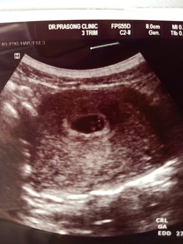 ?6วีค1วัน? เเล้วค่ะ ?เสี่ยงภาวะเเท้งเลือดออก ❤️ตอนนี้น้องปลอดภัยเเล้ว?หัวใจเต้นเร็ว?มากๆค่ะเเม่ๆบ้านอื่นเป้นไงบ้างค่ะ?