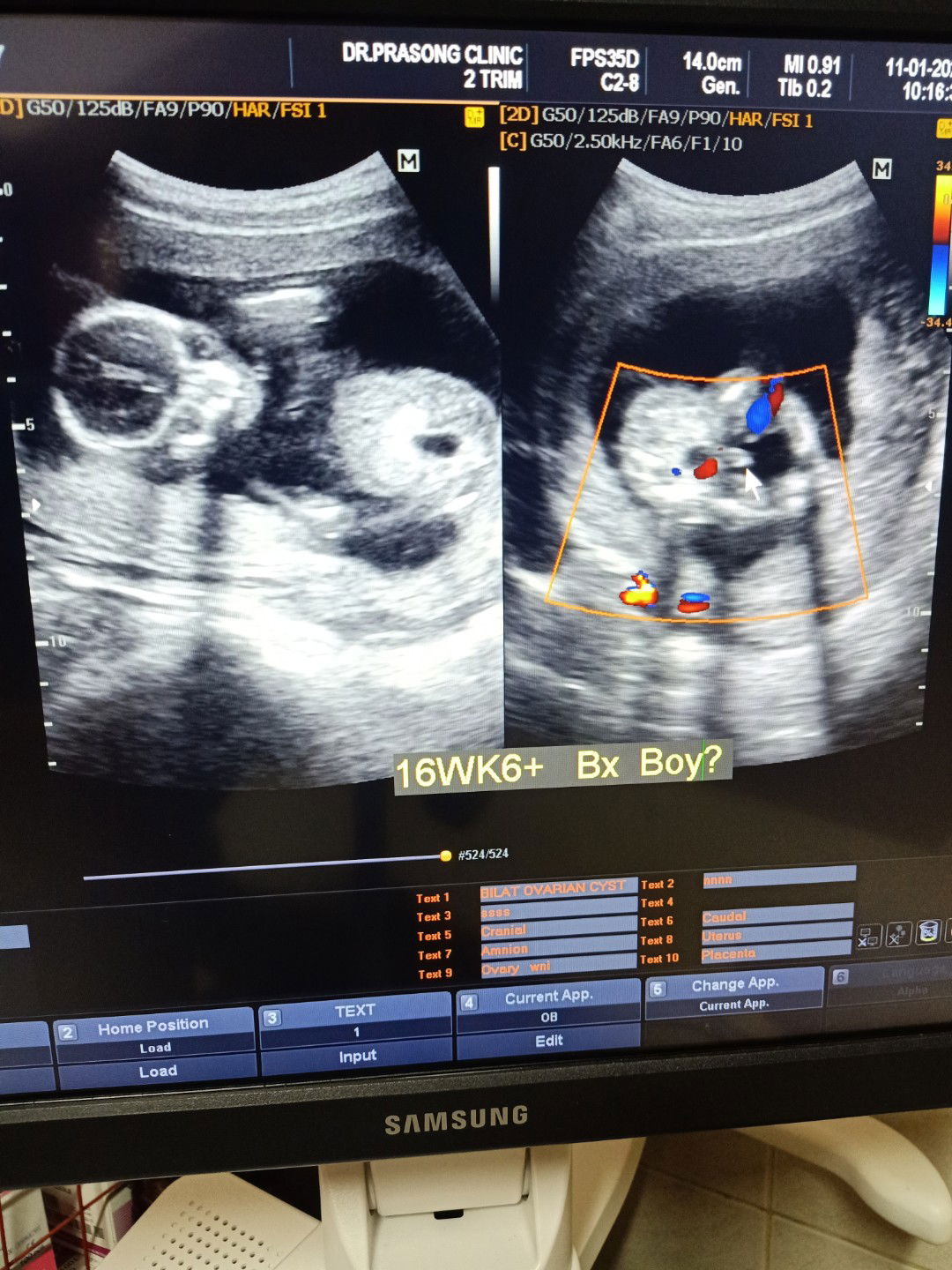 วันนี้น้อง16 วีค+6เเล้ว เเข็งเเรงดีค่ะ ตัวใหญ่มากเเม่ๆบ้านอื่นเป้นไงบ้างค้ะ ผลที่หมอดูรอบนี้ ผช ค้า?