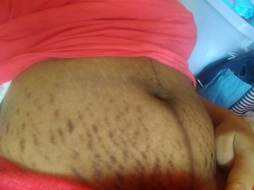 stretch marks