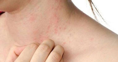 bintik merah tidak gatal