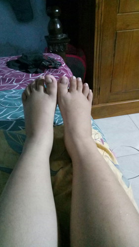 kaki bengkak