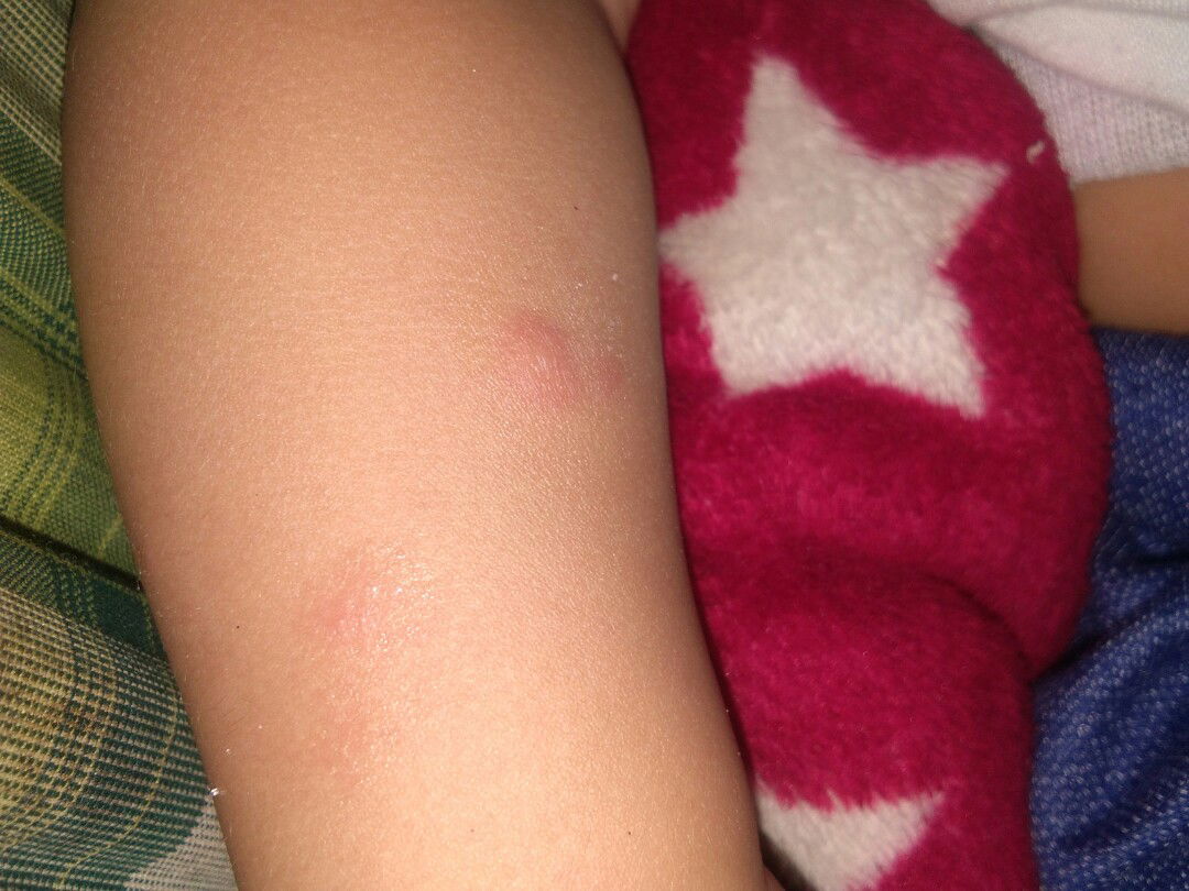 Bentol Merah Seperti Digigit Nyamuk Tapi Banyak