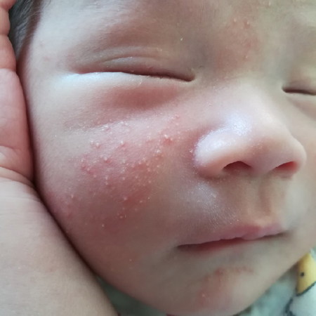 ลูกมีตุ่มขึ้นที่หน้า