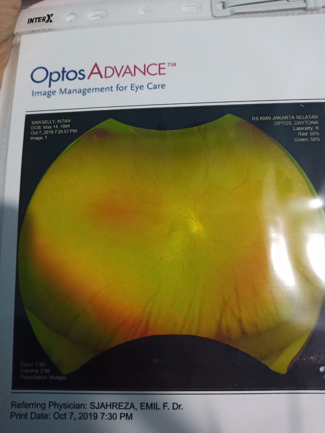 [SHARING]Mata minus tinggi,  bisa normal kah?