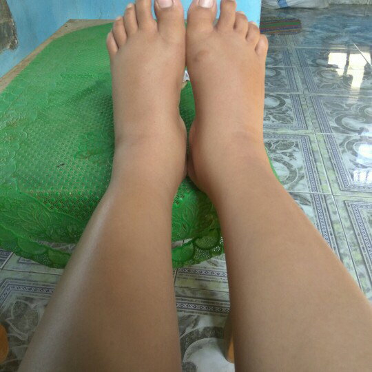kaki bengkak