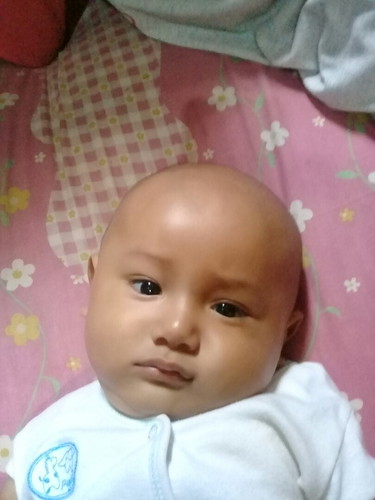 rambut susah tumbuh