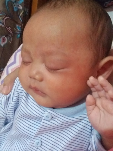Jidat Merah beruntusan