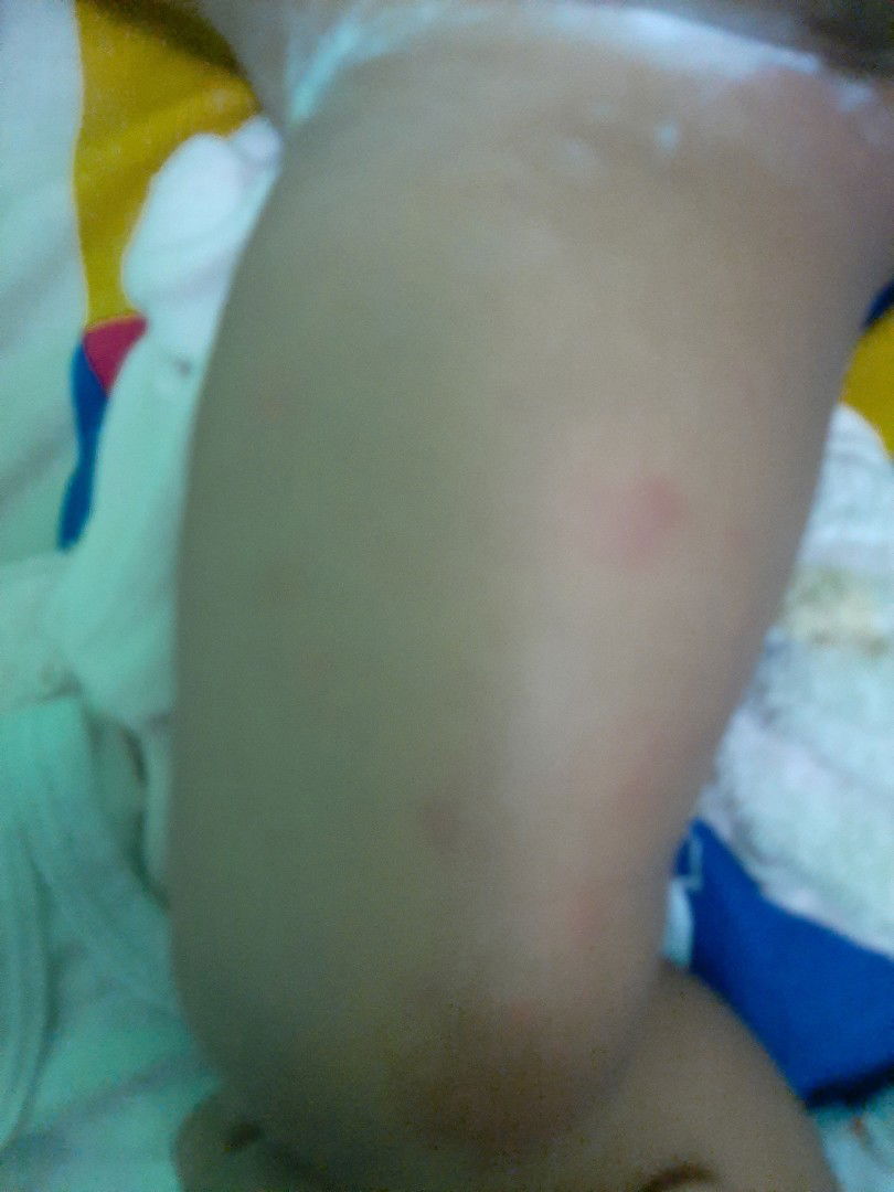 merah" pada tubuh anak