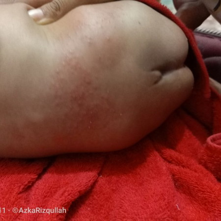 kesehatan anak