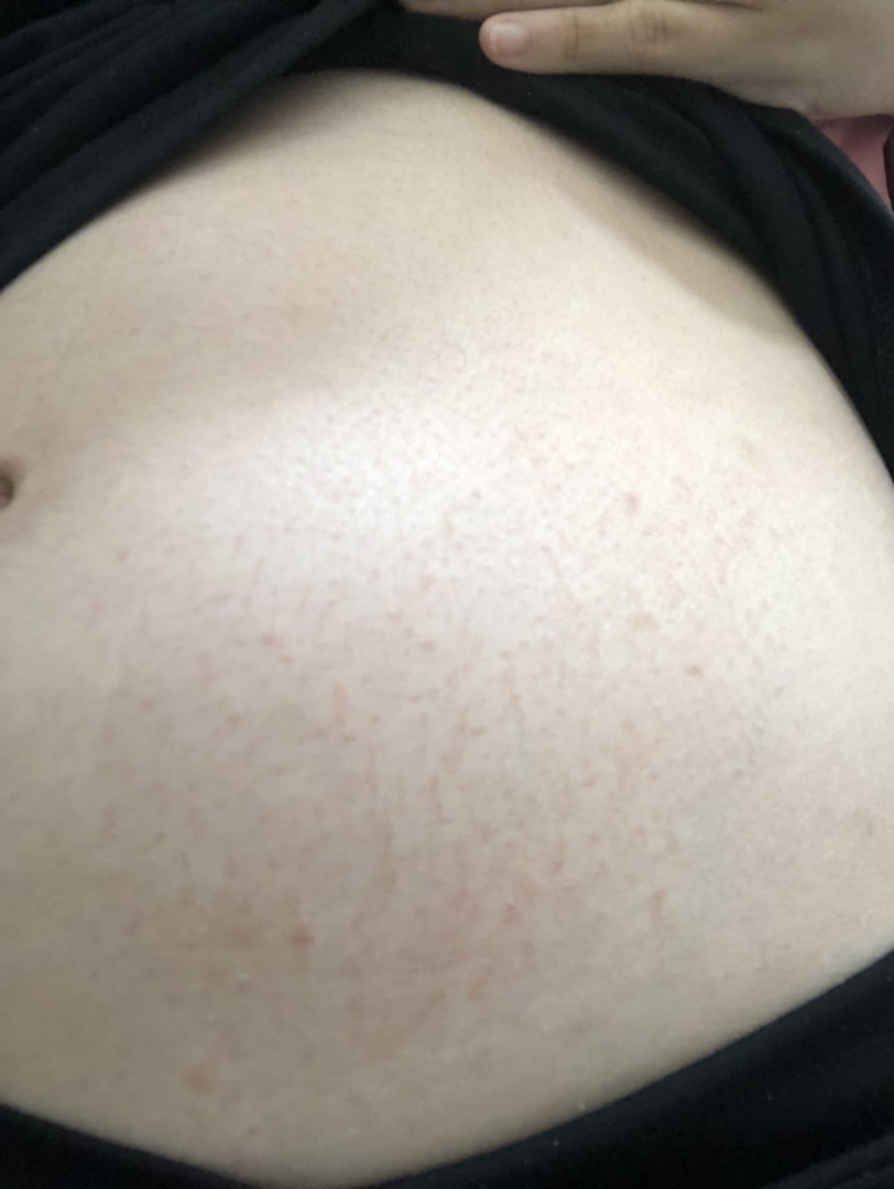 Mẹ bầu bị ngứa bụng