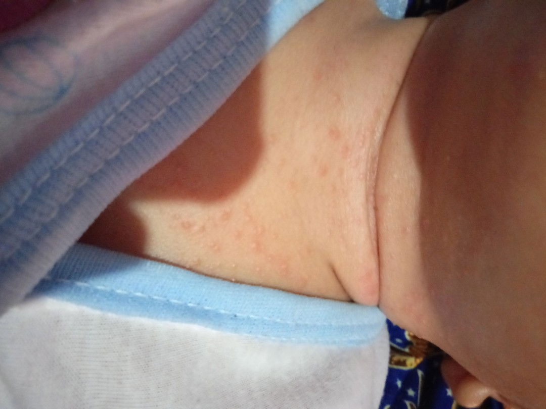 penyebabnya biang keringat / asi??