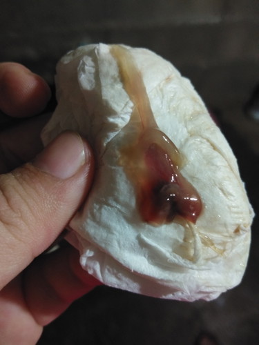 มูกเลือด 39+4