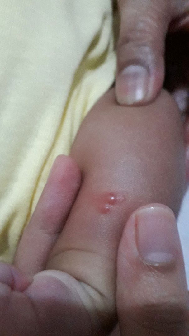 mlenting merah di tangan