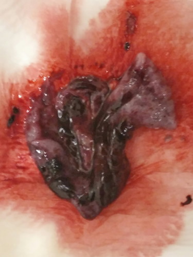 dinugo ako at mai lumabas na matigas. ano po ba ito?