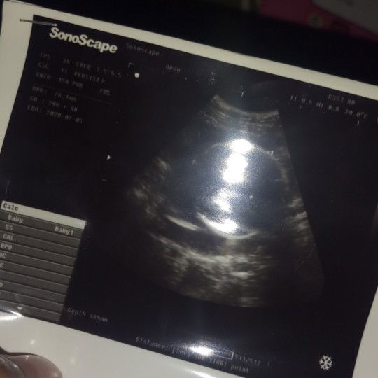 hasil usg bikin bingung