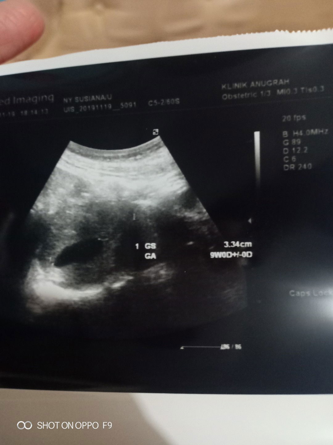 kehamilan kosong padahal udh 9week ?