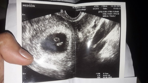 ซาวตอนอายุครรภ์6w4dค่ะ